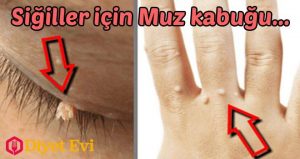 Siğillerin oluşmasına virüsler sebep olduğu için, vücudun diğer bölgelerine kolaylıkla yayılabilir ve hatta temasta bulunduğumuz insanlara da bulaşabilir.Siğilleri yok etmek için bir çok geleneksel tedavi yöntemi vardır, fakat bunlar her zaman %100 etkili olmayabilir ve herkes için aynı şekilde çalışmaz. Eğer geleneksel yöntemlerle siğilleri tedavi edemeyenlerdenseniz, aşağıdaki ev yapımı tedavileri denemek isteyebilirsiniz.Bunlar çok ekonomik, uygulaması kolay yöntemlerdir ve eğer düzenli uygularsanız siğilleri yok etmek için harika işler çıkaracaklardır. Galeriye devam etmek için görselin üzerine tıklamanız yeterli olacaktır
