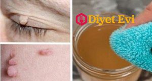 Elma sirkesi ile siğillerden kurtulmak : Cildimizdeki küçük büyümelere fibrom denir. Tıbbi uzmanlara göre bu cilt büyümeleri bağ dokusunun iyi huylu tümörleri olarak adlandırılır. Aslında yumuşak nodüller birkaç milimden 1 santime kadar büyüklükte olabilir. Cildinizle aynı renk ya da bir kaç ton koyu olur. Okumaya devam etmek için görsele tıklayarak 2. fotoğrafa geçin.