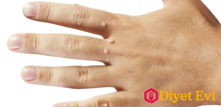 Yaş olarak ortalama 30 yaş insanlarda görülür ve yavaş yavaş yıllar boyunca büyüme gösterirler. Siğiller ve et benleri yapılan araştırmaya göre insanların %99,9 unda bulunur, kimisinde az ve küçük, kiminde ise büyük ve sayı olarak fazla. Tıptaki gelişmeler ile beraber tedavisi oldukça kolay olan et benleri doğal yollar ile de tedavi edilmektedir. 3. fotoğrafa devam etmek için görsele tıklayın.