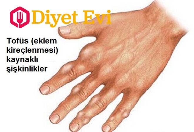 2-Ürik asit hakkında bilmeniz gerekenler: Ciğer, ringa balığı, hamsi, sardalye gibi yiyeceklerde bulunan ve bir tür kimyasal gurubu olan pürinlerin ayrışması sonucunda ürik asit ortaya çıkar. Bazı sebzeler ve süt de pürinleri içerir. Ancak, yapılan çalışmalar, süt ve sebzelerde bulunan pürinlerin vücut sağlığını olumsuz etkilemediğini ve gut riskini arttırmadığını ortaya çıkardı. Okumaya devam etmek için görsele tıklayın ve 3. fotoğrafa geçin.