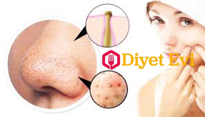 Bu maskeyi bir kaç kere cildinize uygulayarak siyah noktalardan kurtulmak mümkün. İşte gerekli malzemeler: Yemeklerde kullandığınız tuz, naneli diş macunu, 2-3 adet buz küpü. Gerekli malzemeleri temin ettiyseniz nasıl yapıldığını okumak için görsele tıklayın ve 3. fotoğrafa geçin.