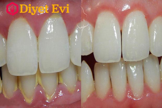 Diş tartarı için evde hazırlaması çok kolay fakat oldukça etkili bir yöntem var. Gerekli malzemeler 40 gram ceviz kabuğu ve 250 ml su.Gerekli malzemeleri hazırladıysanız görsele tıklayarak 3. fotoğrafa geçebilirsiniz.