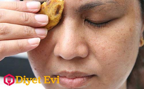 Muz Kabuğu: Muz cilt sağlığı için harika bir meyvedir, içinde siğilleri yok etmeye yarayan proteolitik enzim barındırır. İhtiyacınız olanlar: 1 adet muz kabuğu. Ne Yapacağım? Bir kaşıkla muzun içini çıkartın. Elinizde kalan kabuğu doğrudan siğile uygulayın ve daha sonra siğilin vücudunuzun başka bölgelerine yayılmaması için ellerinizi yıkayın. İstediğiniz sonucu görene kadar bu uygulamayı tekrarlayın. Diğer yöntem için görsele tıklayın