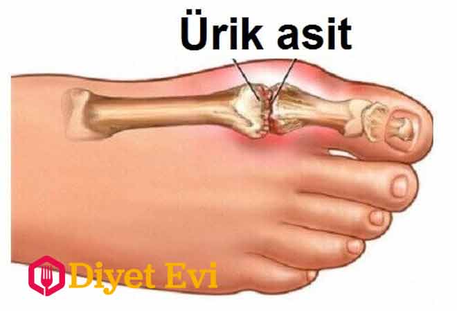3-Hücreler öldüğü zaman ürik asit “geri dönüşüme” uğrar ve kan damarlarının korunmasına yardımcı olur. Böbrekler ise ürik asidin kandan filtrelenip, idrar yoluyla vücuttan atılmasından sorumludur (az miktarda da olsa dışkı yoluyla da atılır). Ancak, ürik asit vücut tarafından çok fazla üretildiği zaman eklemlerde, tendonlarda ve böbrek gibi bazı iç organlarda birikir.Ürik asidi azaltmak veya yok etmek için tarifler ve evde uygulayabileceğiniz yöntemler için galeriye devam edin ve 4. görsele geçin.