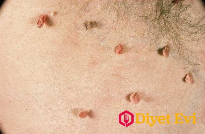 Öncelikle cildiyeye gitmenizi tavsiye ediyoruz. Çünkü doktorun kan tahlili ve bizzat kendisi inceleyerek fibromun iyi huylu olduğunu söylemesi gerekir.Daha sonra ise fibromları doğal yolla tedavi yöntemimize geçebiliriz. Nasıl yapıldığını okumak için görsele tıklayın.