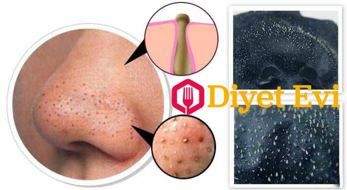 Buzlar eriyene kadar masaja devam ettikten sonra ılık su ile sorunlu bölgeyi durulayın. Pamuklu havlu ile nazikçe kurulayın ve artık siyah noktalardan kurtuldunuz, cildiniz parıl parıl parlıyor ve gözenekleriniz küçüldü ve sıkılaştı. Peki bu malzemeler cildimize ne yaptı da siyah noktalar yok oldu? Okumak için görsele tıklayın.