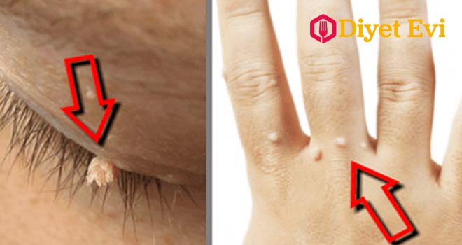 Kara Hindiba: Karahindibanın içindeki süt, siğilleri yok etmek için çok etkilidir. Eğer bahçenizde yetişen karahindibalar varsa, onları siğilleri yok etmek için kullanmaktan çekinmeyin. İhtiyacınız Olanlar: 1 adet karahindiba, Bandaj. Ne Yapacağım? Karahindibanın baş kısmını kopartın ve sapının içindeki sütü çıkartın. Bunu doğrudan siğile uygulayın ve bir bandaj ile kapatın. Bu tedaviyi siğilden kurtuluncaya kadar günde 2 kez uygulayın.