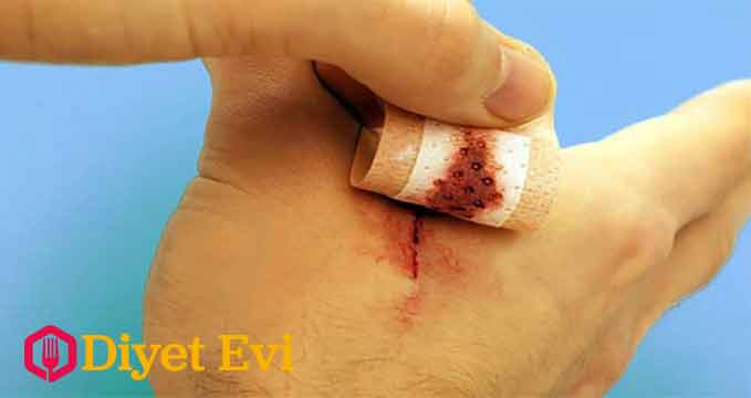 Yaralar için birebir etki içerir: Küçük yaralar ve kesikler için , yanıklar için şifa kaynağı. Ev yapımı zerdeçal macunu ile yanıklar ve deri çürükleri morlukları tedavi edebilirsiniz. Cildinize sürdüğünüzde tamir edici özellik bulunmaktadır. Derideki sedefi ve diğer iltihaplı yaraları tedavi eder. Galeriye devam etmek için görsele tıklayın ve bir sonraki fotoğrafa geçin.