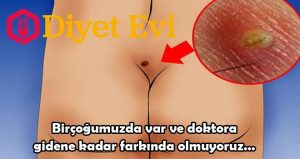 Birçoğumuzda var ve doktora gidene kadar farkında olmuyoruz... Kıl dönmesi belirtileri kıl dönmesi tedavisi : Pilonidal kist kuyruk sokumunda (kalçada) oluşan cilt ve saç atığına denir kabaca. 16-25 yaş aralıklarında kadınlara oranla erkeklerde daha sık görülen bu hastalığın belirtileri ateş ve alt omurgada ağrı şeklindedir. Cerrahi olarak tedavisi mümkün olan bu iltahaplanmanın doğal olarak da tedavileri mevcuttur. İşte o tedavi yöntemleri... İlk olarak Sıcak banyo tedavisini okumak için görsele tıklayın 2. fotoğrafa geçin.