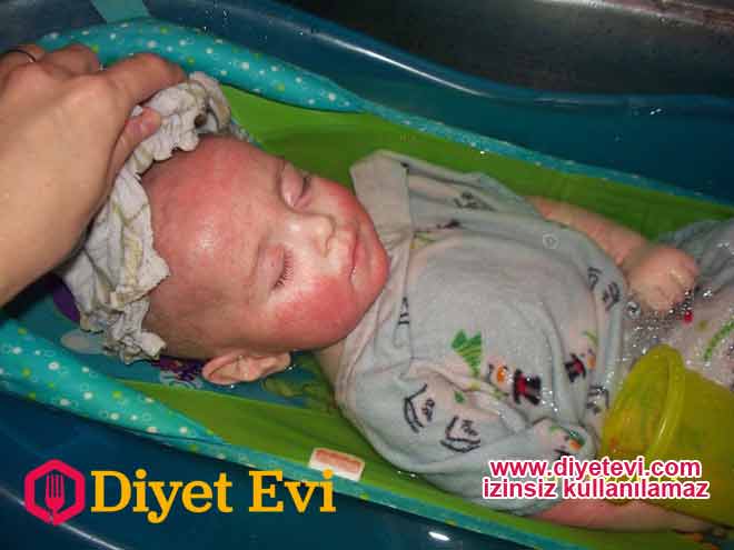 Musa bebek artık uykuya dalabiliyor ve gece boyu aralıksız uyuyabiliyordu. Annesi limon otu ve çinko tozu ile karışım yapıp nemli bir bez ile bebeğinin cildini silmeye başladı ve tedaviyi doğal yollarla destekledi.