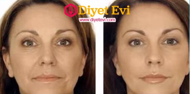 Bir litre suyun içine bir su bardağı zeytinyağı koyup dört saat kısık ateşte kaynatın. Ilındıktan sonra içine alabildiği kadar talk pudrası ilave edin. Yalnız dikkat edin çok katı olmasın. Kek hamuru gibi olsun. Yüzünüze ve vücudunuza sürün. Ara sıra elma suyu ile kompres yapın. Bir diğer karışım için görsele tıklayın ve 4. fotoğrafa geçin.