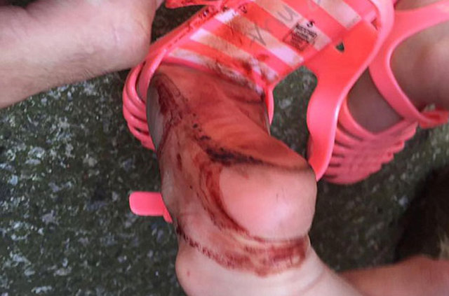 Lisa Conner (26)'ın minik kızına aldığı doğum günü hediyesi pembe silikon sandaletler, 2 yaşındaki Esmé’nin ayağını kan gölüne çevirdi.