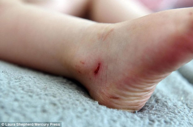 Yarım saat içinde bir ayakkabının bu derece derin bir yara açmasının korkunç bir şey olduğunu belirten anne Conner, 33 liraya aldığı sandaletlere karşı tüm ebeveynleri uyardı.