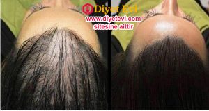 Doğal ve Hızlı Uzayan Saçlar: Ne zaman saç dökülmesi yada kellik şikayeti ile karşılaşsak ilk aklımıza gelen şüphesiz yaşlanma ve bunun sonucunda olan dökülmelerdir. Ama günümüzde saç dökülmesinin sebebi ne yazık ki sadece yaşlanma değil. Modern yaşam tarzı , çevre kirliliği, yaşantımızdaki stres ve son dönemdeki genetiği bozulmuş gıdalar. Hatta öyle ki gencecik insanlarda bile bu sebeplerden saçlar dökülmekte. Devam etmek için görsele tıklayın ve 2. fotoğrafa geçin.