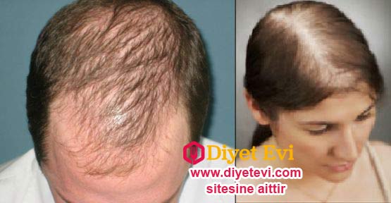 Saç dökülmesi gerek bayanlarda olsun gerekse erkeklerde büyük bir tehdit haline gelmiştir. İnsanlar genellikle eski saçlı görüntülerine kavuşmak için farklı yöntemlere başvurmaktadır. Tüm bu kimyasal çözümler istenilen sonuçlar vermemekte en sonunda da insanlar çareyi saç ektirmekte bulmaktadır. Tabi bu saç ekimi de pahalı olduğu için bir çok kişi tarafından uygulanamamaktadır. Peki hem para vermeden hem de kimyasal ürün kullanmadan saç dökülme sorununu nasıl engelleriz? Devam etmek için görsele tıklayın ve 3. fotoğrafa geçin.