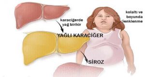 Yağlanmış Karaciğer Nedir? Buna Ne Sebep Olur? Tıpta yağlanmış karaciğer, hepatik steatoz olarak bilinir. Öncelikle, bunun iyi huylu bir hastalık olduğunu belirtmeliyiz; fakat, eğer düzgün tedavi edilmezse ve dikkat etmezseniz, uzun sürede daha ciddi hastalıklara yol açacaktır. Genel konuşmak gerekirse, karaciğerde biriken yağ asitleri ve trigliseritler hastalığa yol açar. Karaciğer “işlevini yitirir”, daha önce temizlediği toksinleri temizleyemez ve metabolik fonksiyonlarını sürdüremez hale gelir. Karaciğerde aşırı yağ biriktiğinde, karaciğer bu yağdan kurtulmaya çalışırken içinde küçük yaralar açıldığını bilmelisiniz. Zamanla, bu hasar görmüş dokular birikerek, siroza dönüşebilir. Doktorlar, hepimizin karaciğerinde yağ olduğunu söylüyor. Fakat bu yağ oranı %10’u geçerse, hepatik steatoza maruz kalmış oluyoruz. Bu durum karaciğer tarafından başarılı bir şekilde işlenemeyen zararlı maddelerin kanda görülmesiyle ortaya çıkarılabilir. Enflamasyondan ve sürekli ağrılardan söz etmiyoruz bile. Yağlanmış Karaciğere Neden Olan Şeyleri öğrenmek için görsele tıklayın ve 2. fotoğrafa geçin.