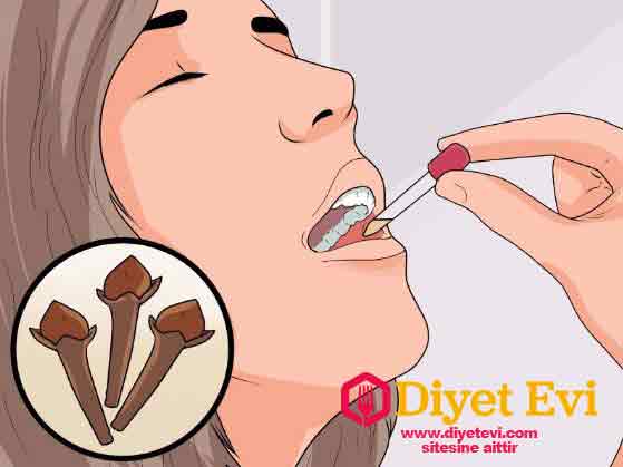 Diş ağrılarını gidermenin doğal yolu için gerekli Malzemeler : Karanfil Tozu ; Hindistan Cevizi Yağı.Gerekli malzemeleri temin ettiyseniz yapılışına geçelim. Yapılışı: Yarım çay kaşığı karanfil tozu ve yarım çay kaşığı hindistan cevizi yağını bir çay tabağına koyarak macun kıvamına gelene kadar karıştırın. Oluşan bu karışımı ağrıyan dişimizin üzerine yada diş etimizin üzerine çay kaşığı yada pamuk çubuğu ile ağrıyan yerin tamamını kapatacak şekilde sürün. Günde 3 kere bu şekilde ağrıyan yerinize sürebilirsiniz.Peki nasıl oluyor da bu karışım ağrınızı alıyor ? Sebebini öğrenmek için görsele tıklayın ve 4. fotoğrafa geçin.