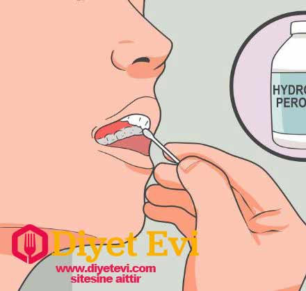 Peki nasıl oluyor da bu karışım ağrınızı alıyor ? Hindistan cevizi yağı içinde barındırdığı analjezik maddeler ve toz karanfilde bulunan antibakteriyel madde nedeniyle ağrılarınızı dindirir. Diş ağrılarına ne iyi gelir?, Diş ağrısı en çabuk nasıl geçer, Diş ağrısını geçiren doğal karışımlar, Diş ağrısına bitkisel çare kelimelerini aratarak bu habere geldiniz. www.diyetevi.com sitesne aittir. Lütfen paylaşarak daha fazla insanın ulaşmasını sağlayın.