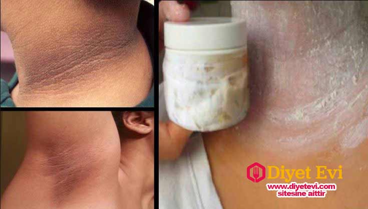 Kabartma tozu, zeytinyağı ve tuz. Evet bu herkesin evinde olan doğal ürünler ile yapacağımız kür ile bu koyu izlerden kurtulabilirsiniz. Malzemelerin miktarı: 1 çorba kaşığı kabartma tozu, 1 çorba kaşığı zeytinyağı, 1 çorba kaşığı tuz. Gerekli malzemeleri temin ettiyseniz yapılışına geçebiliriz. Tarifin nasıl yapıldığını okumak için görsele tıklayın ve 3. fotoğrafa geçin.