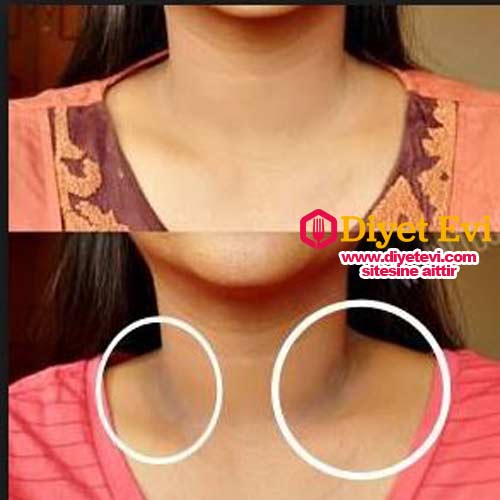 Yapılışı : Bu 3 malzemeyi bir kapta karıştırarak cıvık hamur kıvamına gelene kadar yoğurun. Koyu olan yerlere bu karışımı sürerek 15 dakika bekleyin. Sonrasında soğuk su ile durulayın. Bu uygulamayı haftada 3 kere uygulayın. 1 ay sonrasında farkı sizde hissedeceksiniz. Tuzun cinsi bu tarifte önemli.,Evde kullanılan softa tuzu işe yaramıyor.... Sebebini öğrenmek için görsele tıklayın ve son fotoğrafa geçin.