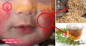 Evdeki malzemeler ile alerjik egzama nasıl geçer: Allerjik egzema olarak bilinen atopik dermatit çocuklarda daha sık görülen kolay kolay geçmeyen aksine tekrarlayan ve kaşıntılı lezyonlarla kendini gösteren kronik bir deri hastalığıdır. Vücudun farklı bölgelerinde yer alır; kir,nem ve ısı başlıca yayılma nedenleridir. Mantar ve bakteri ciltte kolayca çoğalır.Deride kuruluk, hassasiyet ve kızarıklık gelişir. Çocukların %10-20, erişkinlerin %1-3’ünü etkiler. Bebeklerde Alerjik Egzamanın Tipleri ve tedavisi için görsele tıklayın ve 2. fotoğrafa geçin.