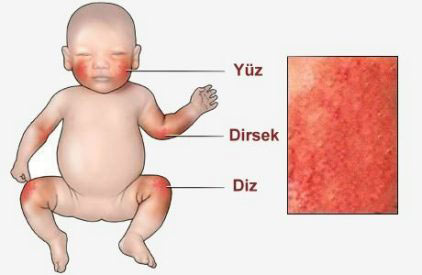 Alerjik Egzama:Bu tip sorunlarda cilt şişer ve kırmızı pul pul hale gelir. 2 ve 18 aylık bebekler arasında görülür. Ve diğer tür egzamalara göre daha zahmetlidir. Genellikle artan terleme ile egzamanın görüldüğü yerler artarak yayılır. Genetik , alerjik yada psikolojik nedenlerden de kaynaklanabilir. Bu durumlarda antibiyotik çözümüne gidilmekte. Etkilenen bölge daha özenle kurutulmalı su ile temaslar azaltılmalı.Giyilen elbiseler %100 pamuklu seçilmeli. Malzemeler: Hindistan cevizi yağı yaklaşık 30 gram ( 2 çorba kaşığı ), 2 Dal Kekik, 2 yemek kaşığı yulaf, 1 litre maden suyu... Okumaya devam etmek için görsele tıklayın ve 3. fotoğrafa geçin.
