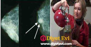 Bu Çaydan her gün içerek Meme Kanseri Tedavi etti! Şimdi her kadına bunu öneriyor! Vereceğimiz tarif her tür kansere iyi geldiği, tümörlerin küçülmesine yardımcı olduğu iddia ediliyor! Meme kanseri kadınlarda en sık görülen kanserlerden biridir. Meme kanserinde erken teşhis, kadınların kanserle savaşma şansını elde etmeleri için çok önemlidir.Bu yüzden bugün, bu çirkin hastalığa karşı savaşan bir kadından alınan tarifi sizlere ulaştıracağız.Umarım faydasını görürsünüz. 2 görsele geçmek için fotoğrafa tıklayın.