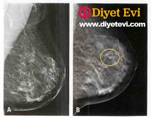 Göğüs kanserinin ana belirtileri göğüste düğüm ve düğümlerin ortaya çıkması ve cilt rengindeki değişikliklerdir. Östrojen fazlalığının tümör büyümesini daha da arttıracağı bilinmektedir. Özetlersek bu tarif, metabolizmayı etkilememesi ve östrojenin emilmesine yardımcı olmasını sağlayan belirli gıdaların alınması prensibine dayanıyor... Mucize karışım: • 15 gram taze yonca • 5 gram taze Sarı kantaron otu • 1 ahududu yaprağı Hazırlanışına geçmek için görsele tıklayın.