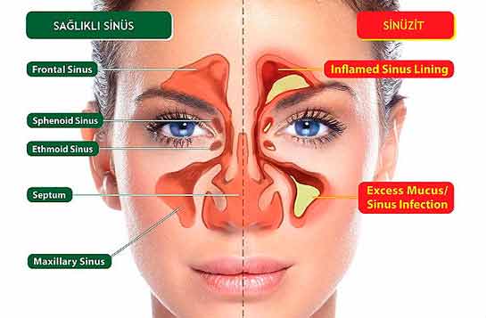 Malzemeler: -Elma sirkesi ve Zencefil. Bu iki malzeme tedaviniz için yeterlidir. Hemen yapılışına geçelim: Zencefili rendeleyin ve bir cam kaseye koyun içerisine elma sirkesi ekleyin ara sıra karıştırmak suretiyle 10 gün boyunca cam kavanozda bekletin. 10 günün sonunda karışımı kaynatın ve kafanızı büyük bir havlu ile örterek karışımın buharını burnunuzdan alıp ağzınızdan verin. Bu işlemi 15 dakika devam ettirin. Görsele tıklayarak 3. fotoğrafa geçin ve yazımızı okumaya devam edin.