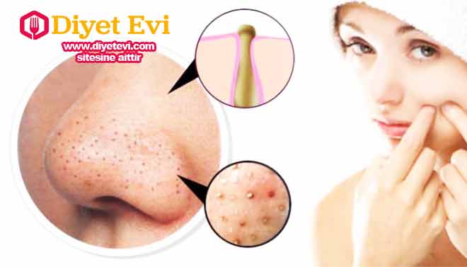 Siyah nokta maskesi için gerekli malzemeler: Diş macunu, yüz temizliği için fırça, 1/4 çay kaşığı kadar tuz, Steril gazlı bez, su (kaynatılmış papatya suyu da olur ), yarım çay kaşığı beyaz kil, 1- çay kaşığı yoğurt (krem de olur). Gerekli malzemeleri temin ettiyseniz bir sonraki fotoğrafa tıklayarak tarif ve yapılışını öğrenmek için geçebilirsiniz.