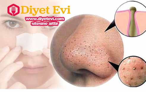 Siyah nokta maskesi yapılışı: 3 adımdan oluşan bu uygulamanın ilk adımına ciltteki yağ oranını azaltmak için diş macununa tuz koyarak sorunlu bölgelerimize hafifçe masaj yaparak sürelim. Daha sonra küçük bir parça steril gazlı beze sıçak su yada papatya suyunu sürelim ve sorunlu bölgemize bastıralım. yaklaşık 25 dk kadar bu şekilde ıslak bez cildimizde kalmalı. Bu işlem yağ oranı azaltılmış sorunlu bölgenin yumuşayarak genişlemesini ve gözeneklerin açılmasını sağlayacak. Üçüncü ve en önemli kısıma geçmek için görsele tıklayın ve son fotoğrafa geçin.