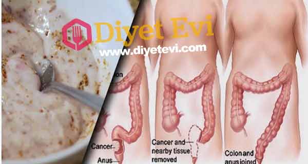 Bağırsak temizleme diyeti nasıl hazırlanır: Bütün malzemeleri chia tohumu hariç bir bardağa doldurun ve üzerine su ilave edin hepsi karıştıktan sonra en son chia tohumunu ekleyin ve 5 dakika kadar karıştırın. Bu karışımı sabahları aç karnına için ve 3 hafta kadar devam edin. Daha iyi sonuç almak için bol sıvı tüketin(yaklaşık 2 litre) ve bağırsakları boşaltmaya teşvik edin. 3 haftanın sonunda bağırsaklarınız toksinlerden arınmış ve 10 kilo zayıflamış olacaksınız. Yazının başında belirttiğimiz şikayetlerden de kurtulmuş olarak hayatınıza daha kaliteli olarak devam edeceksiniz. Devam etmek için görsele tıklayın ve son fotoğrafa geçin.