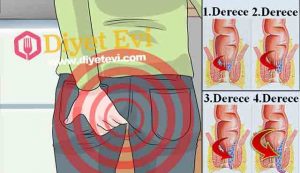 Doktor Ender Saraç Yöntemi ile Basura bitkisel çözüm: Hemoroid (Basur), toplumda çok sık görülmesine rağmen, gizli saklı yaşanan bir hastalıktır. Hareketsiz yaşam, mesleki nedenler ve kalıtsal yatkınlık hemoroide neden olan en önemli etkenlerdir. İnsan hayatını kabusa çeviren bu rahatsızlık için, Dr. Ender Saraç’ın tavsiyelerine kulak vermek ister misiniz? Sağlıklı Yaşam Uzmanı Ender Saraç, evde kolaylıkla uygulayabileceğiniz bazı bitkisel tedavilerle sizlere yardımcı oluyor. Dr. Ender Saraç’ın Hemoroid(Basur) için Önerileri : Görsele tıklayarak 2. fotoğrafa geçin ve okumaya devam edin.