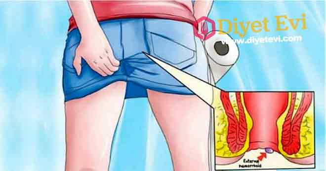 Hemoroid (Basur) için Bitkisel Formüller : Gotu kola, aloe vera, rutin biyoflavonoidi ve bazı ayurveda tabletleri genel varis eğilimini azaltarak yararlı olabilir. Hemoroid (Basur) için Bitki Çayları : Kuşburnu ve kök zerdeçaldan karışım çay yapıp içmek ayrıca günde en az 2 litre ılık sıvı içmek bu konuda çok faydalıdır. Hemoroide (Basur) İyi Gelen Baharatlar : Kara halle, yoğun burucu özelliğinden dolayı özellikle hemoroitte çok faydalıdır. Kara halleyi tüketebilmek için, çekirdekleri, teflon tavada çok az miktarda sıvıyağla sürekli karıştırıp yavaşça kavurmak gerekir. Son derece buruk bir tadı olan kara halle ağza alındığı andan itibaren büzüştürmeye başlar. Yemeklerden sonra günde 2-3 kez, 1 adet kavrulmuş kara halle çekirdeğini çiğneyip yutmak hemoroite karşı tedavide ve korunmada oldukça yararlıdır. 3. görsele geçmek için fotoğrafa tıklayın.