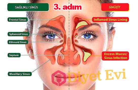 Sinüzit tedavisi için Malzemeler: Yarım fincann Su 1 yemek kaşığı elma sirkesi 1 çorba kaşığı bal 1 çay kaşığı acı biber 1 limon suyu Yapılışı ve kullanımı için görsele tıklayın.