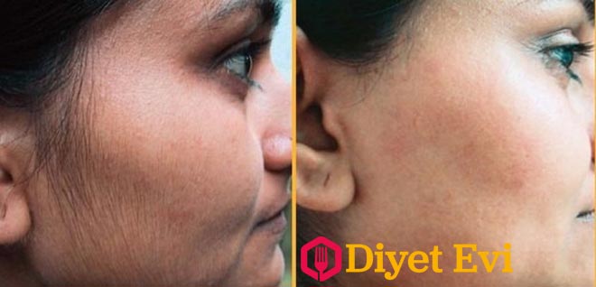 Kullanılışı • Bütün maddeleri bir kapta yapışkan bir kıvama gelinceye kadar karıştırın. • Karışımı, vücudunuzda, tüylerden kurtulmak istediğiniz bölgelere uygulayın. • Eksfoliant kullanırmış gibi, karışımı nazik yuvarlak hareketlerle cildinizde ovun. • Tüylerden tamamen kurtulmak için, bu karışım ile tüylerin çıkış yönünün tersine doğru masaj yapın. • Bitirmek için, su dengesini sağlayacak bir krem ile cildinizi nemlendirin. • En iyi sonuçları almak ve yumuşak bir cilde kavuşmak istiyorsanız, bu tedaviyi haftada 2-3 kez uygulayın. Bu doğal tedavi cilt tipine göre çalışmaktadır, bu sebepten dolayı bu tedaviyi uygulayan herkes aynı sonuçları alacak diye bir şey yoktur. Bazı kadınlar bunu denedikten 1-2 hafta sonra sonuçları görürken, bazıları da sonuçları 1 ay uygulamadan sonra görebilmiştir. Son fotoğrafa geçmek ve yazımızı bitirmek için görsele tıklayın