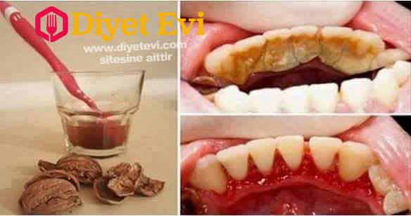 Hazırlanışı: Öncelikle ceviz kabuklarını suyun içine atın ve kapağı kapalı şekilde 20 dakika kaynatın, suyumuz kaynamaya başladıktan sonra altını kapatın ve 10 dakika da bu şekilde soğumaya bırakın. Daha sonra diş fırçamızı bu suya batırıp dişlerimizi güzelce fırçalıyoruz. Okumaya devam etmek için görsele tıklayın.