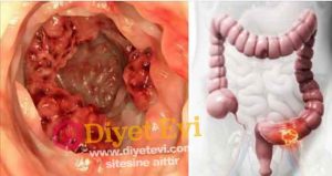 Üzüm çekirdeği kanserli hücreleri öldürüyor