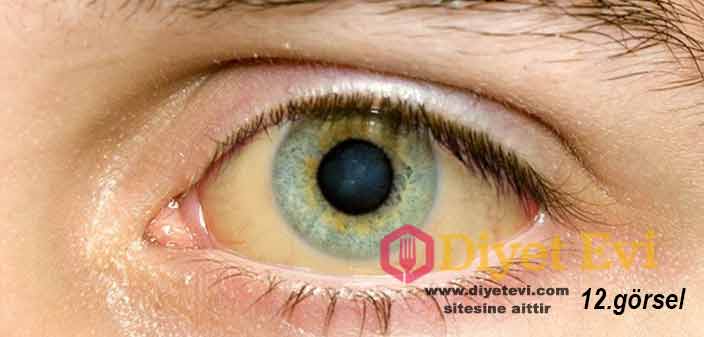 Çoğu zaman, karaciğer ve safra kanallarının işlevselliğinde azalma ile kendini gösterir. Sarılığın ana semptomu olabilir. (kaynak: https://brightside.me/inspiration-health/12-things-your-eyes-can-tell-about-your-health-327410/ )