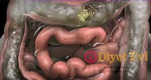 5 dakikada bağırsakları temizleyen karışım